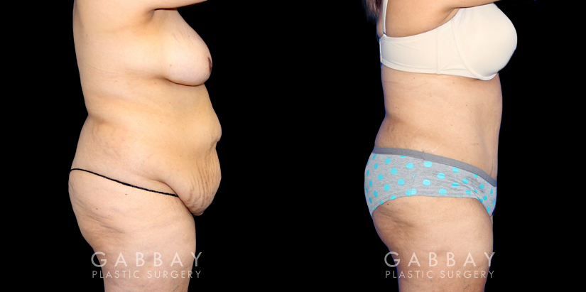 Tummy Tuck Before and After Photo Gallery, Page 2 of 4