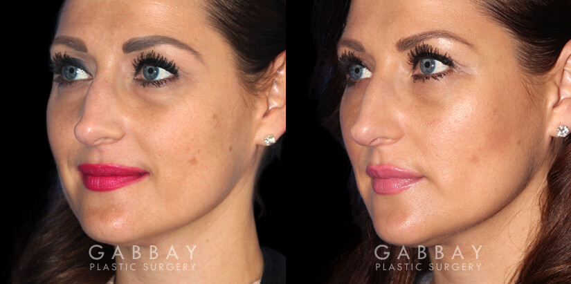 Patient 01 3/4th Left Side View Upper Eyelid Blepharoplasty with Fat Transfer to Face Gabbay Plastic Surgery