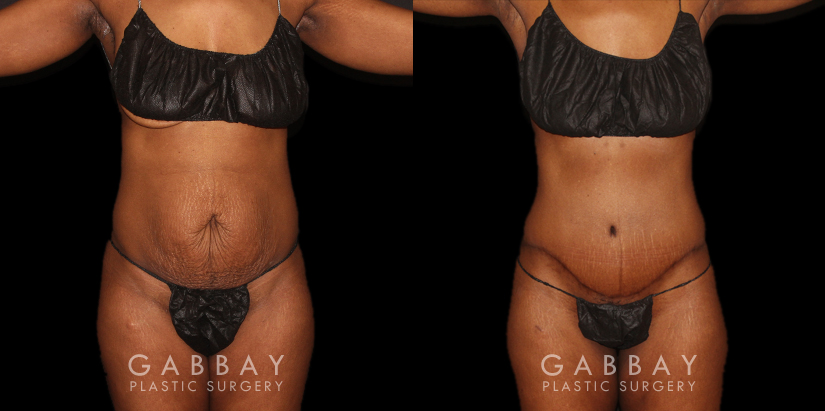 Patient following tummy tuck and hernia repair, showcasing results from multiple angles. Note the absence of stomach overhang in the leaning forward position, demonstrating effective tightening of multiple tissue layers.