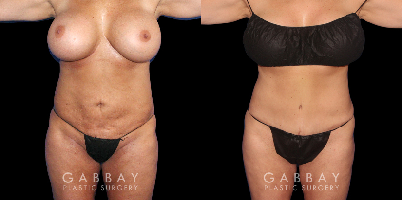 Female tummy tuck patient before and after precise abdominoplasty. Patient had minor, stubborn fat pockets removed and then the abdominal skin was tightened to restore a youthful firmness and texture.