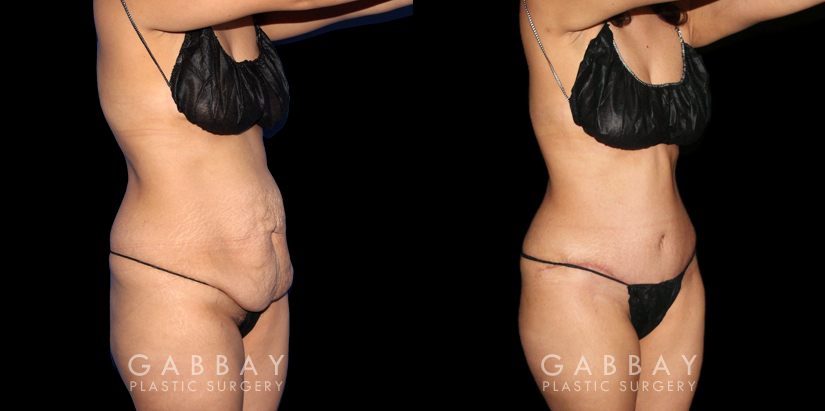 Multi-angle view of patient before and after tummy tuck combined with waist and arm liposuction. The combined approach allowed for results that balanced well with each other, creating a firmer body contour that maintained a natural look.