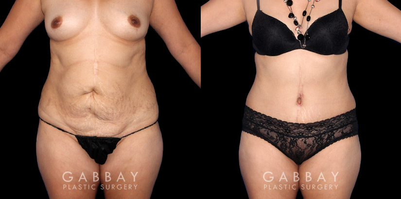 Female tummy tuck patient before and after her procedure, showcasing effective tightening of excess skin following weight loss. Her abdominoplasty was effective for getting her to her final aesthetic results with a smooth recovery and mild downtime.