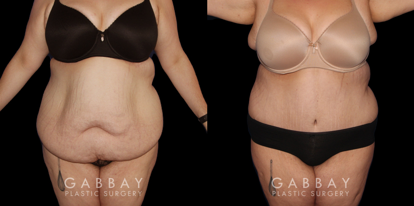 Abdominoplasty patient results, highlighting the loose skin and folds before the procedure. Following surgery, the patient recovered without complications and saw lasting tummy tuck results with a flatter profile.