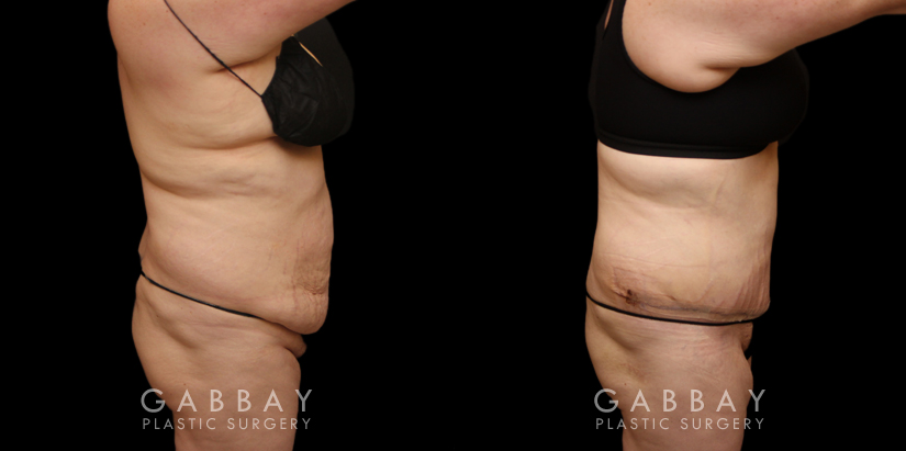 Patient before and after tummy tuck combined with breast lift. The tightening of the abdomen along with the repositioning of the breasts creates a more balanced aesthetic with tighter skin.