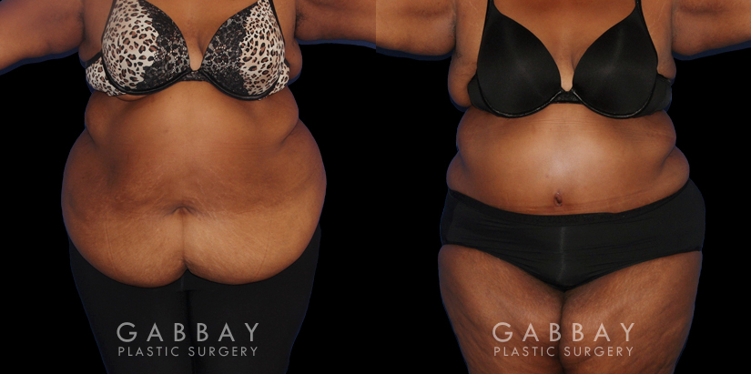 Patient photos showing before and after abdominoplasty procedure. Before surgery, the patient had significant banding and loose skin over the abdomen. Following liposuction to multiple areas combined with surgical excision of excess skin, the final result is a tighter, firmer look.