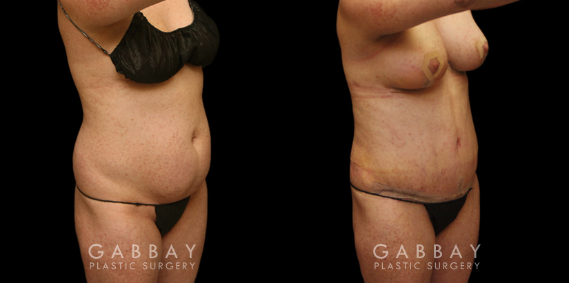 Patient before and after tummy tuck combined with breast augmentation and breast lift. By increasing breast volume, heightening breast position, and tightening the abdominal area, the patient has a slimmer, yet feminine figure.