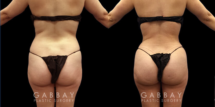 Non-Surgical Sculptra Butt Lift (BBL)  South Florida Center for Cosmetic  Surgery