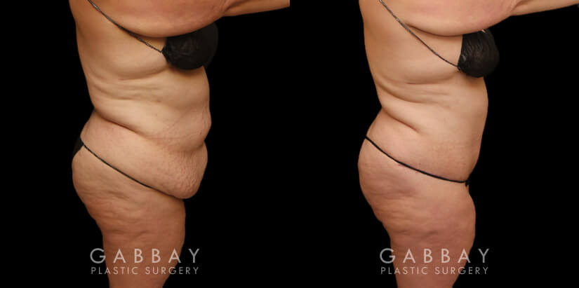 Patient 01 Right Side View Abdominoplasty with lipo Gabbay Plastic Surgery