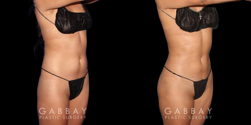 Multiple angle view of Caucasian patient in her mid-30s before and after mini Brazilian butt lift surgery and combined 360 liposuction for body contouring and butt augmentation. Liposuction provided improved abdominal contouring focusing on the abdomen, waist, and tailbone areas. The transferred fat settled well into round-shaped buttocks for a stable cosmetic enhancement as part of this skinny BBL.