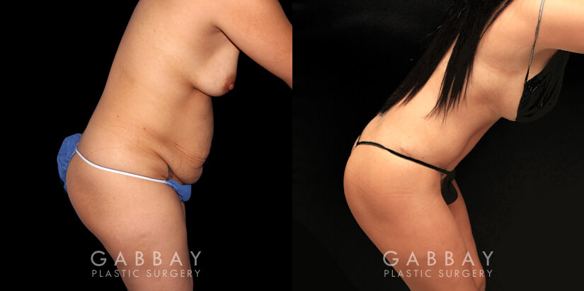 Mommy makeover before-and-after showing tightened abdomen, increased breast size and improved shape, and significant fat reduction for a slimmer contour. This patient’s mommy makeover involved 360 liposuction, a tummy tuck, and breast augmentation. All procedures were completed in a single visit and she saw a smoother recovery with complete healing on time. Note the lack of visible scarring from each angle.