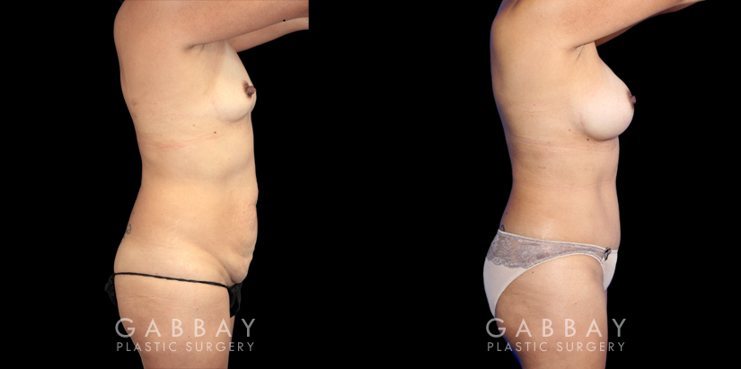 Patient 03 Right Side View Augmentation Silicone, Abdominoplasty, Flank Liposuction Gabbay Plastic Surgery