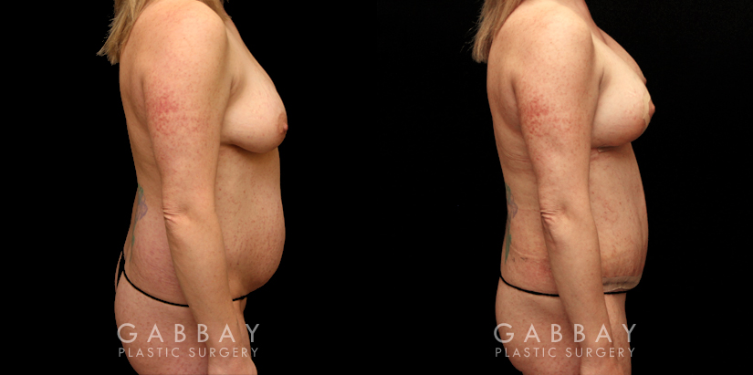 Before and after a mommy makeover consisting of two procedures: tummy tuck and a breast lift. Drooping breasts were repositioned to a higher, firmer aesthetic while targeted abdominal liposuction and tightening restored a prepregnancy contour to the body and silhouette.