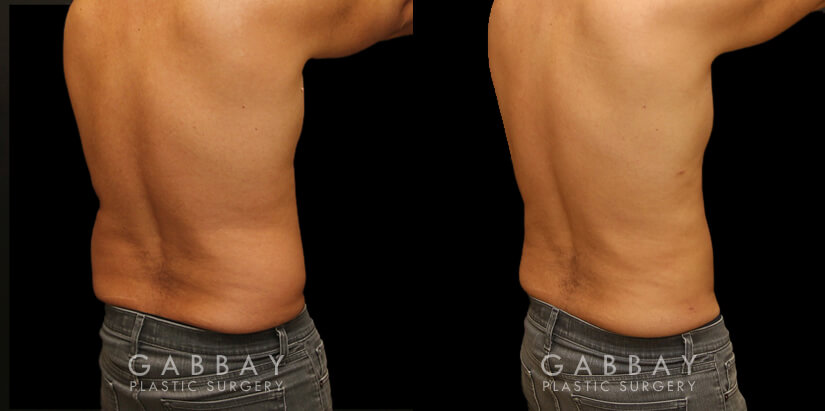 Patient 01 4/5th Right Side View Lipo Male Gabbay Plastic Surgery