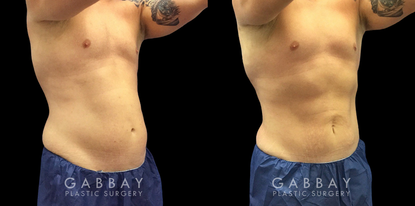 Male patient after abdominal liposuction, improving the patient’s torso shape and resulting in a more masculine contour from each angle with a flat abdomen. Compare to the sloping belly roundness before.