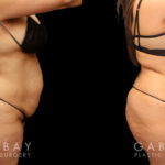 Patient photos from before and after tummy tuck. The full procedure combined abdominal tightening with liposuction, resulting in significant slimming of the front. Patient recovered smoothly with no complications.