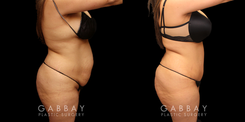 Patient photos from before and after tummy tuck. The full procedure combined abdominal tightening with liposuction, resulting in significant slimming of the front. Patient recovered smoothly with no complications.