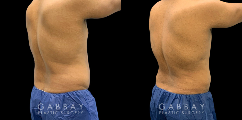 Male patient following 360 liposuction to the abdomen, sides, and back for a more youthful contour while maintaining a masculine feel to the body shape. The result is a tighter overall torso appearance.