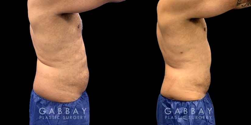 Male liposuction before-and-after photo for 360 lipo showing a result in a slimmer waist and flatter abdominal area for an enhanced torso contour. Flanks are significantly slimmed and present a toned silhouette.