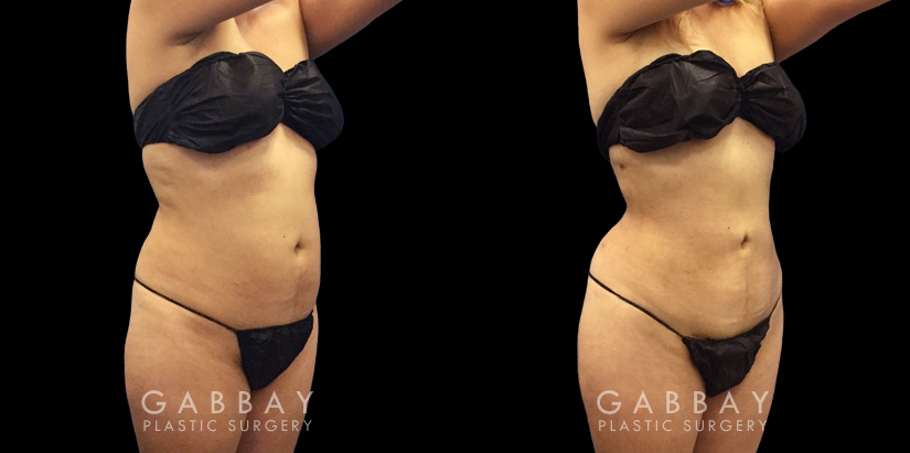 Female patient in her early 40s after abdominal liposuction surgery. Patient’s procedure was straightforward with an uncomplicated recovery period and notable results.