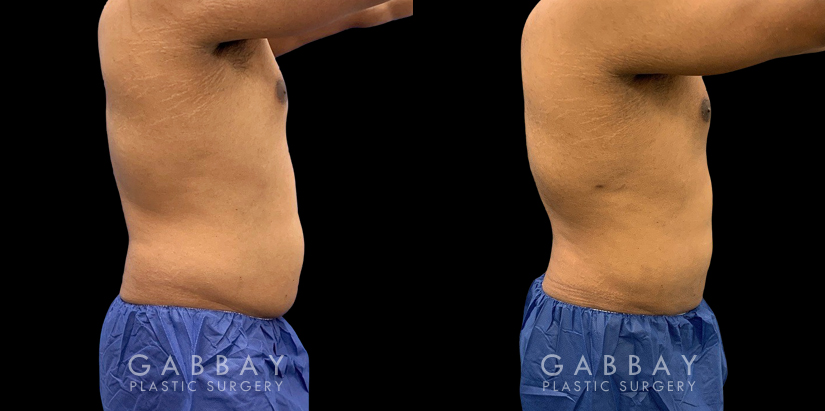 Male patient after surgical removal of abdominal fat. His liposuction results emphasize the naturally masculine form of his torso with a tighter figure overall.