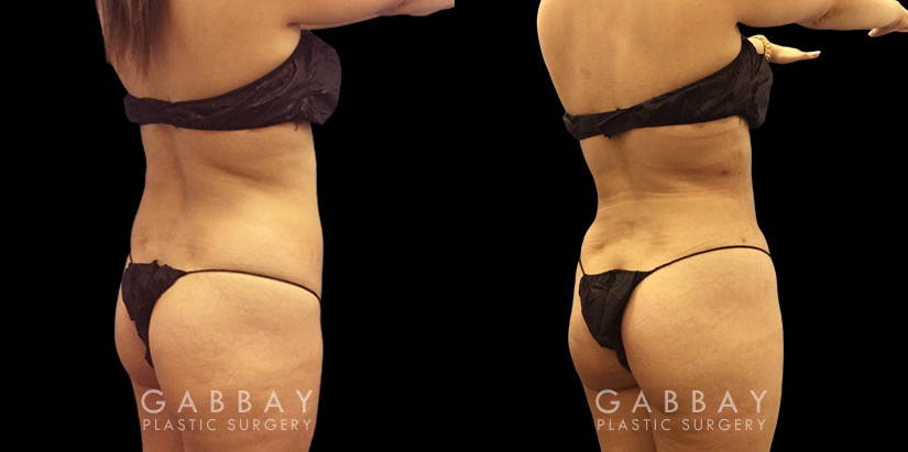 Female patient before and after belly liposuction, enhancing her figure while providing a flatter stomach visible from the side and front. Note the lack of visible scarring.