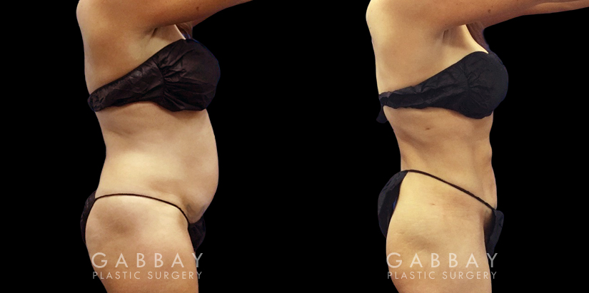 Following her abdominal liposuction, this female patient in her late 30s saw a smooth recovery period with results that gave her a significantly flatter stomach with no belly overhang.