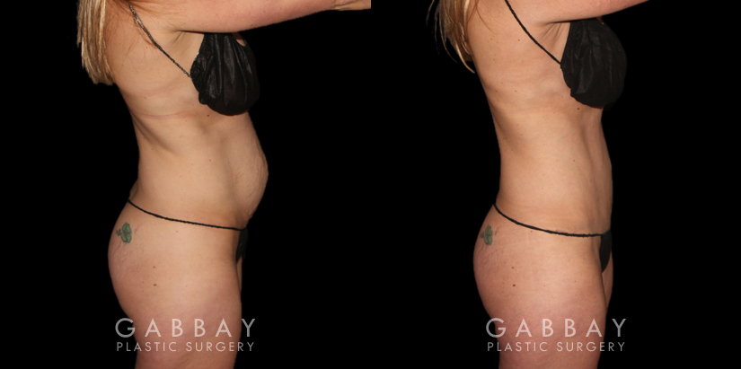 Patient 03 Right Side View Tummy Tuck Gabbay Plastic Surgery
