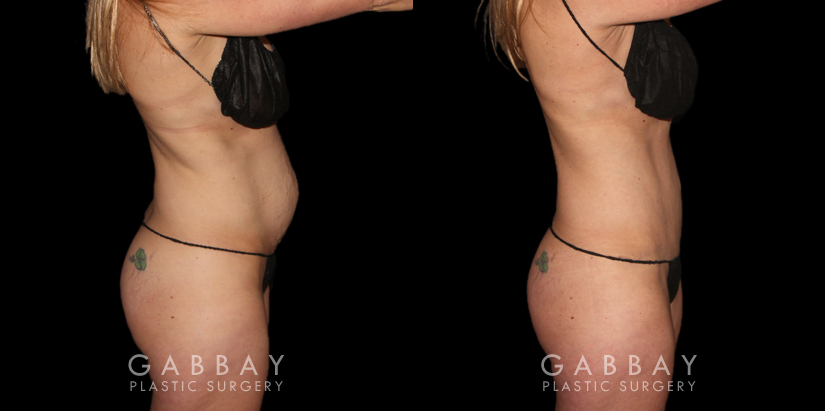 Patient results from tummy tuck. Note before the loose, hanging area at the lower abdomen. Following fat removal and abdominal tightening, the patient achieved a slim, refined silhouette.