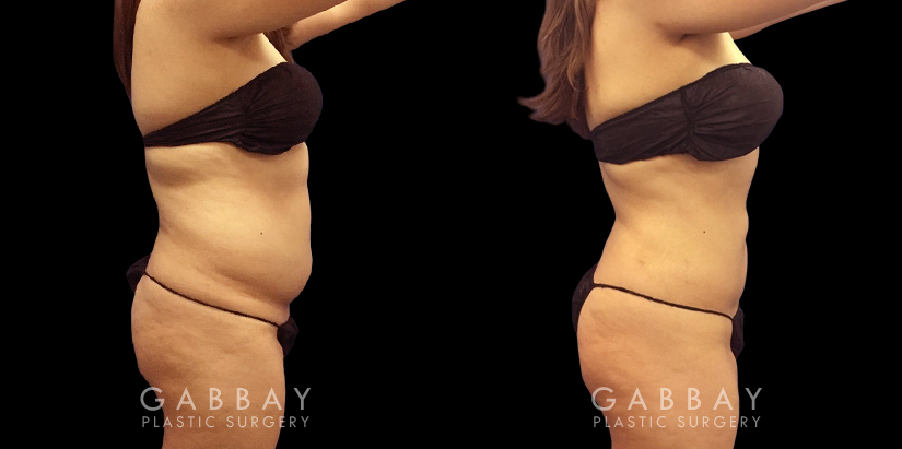 Patient’s surgical belly fat removal results reveal significant slimming after her procedure, with virtually no belly overhang for a flat profile contour.