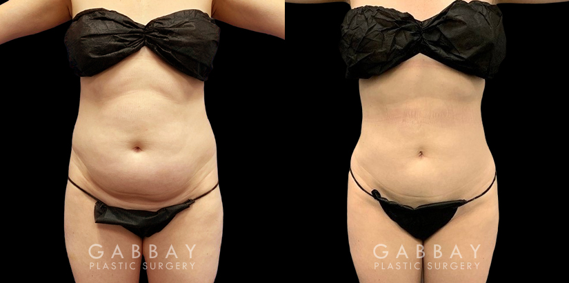 Female patient wanted to target stubborn belly fat. With one lipo procedure for her abdomen, she attained a smooth below with significant improvement and a smooth recovery experience.