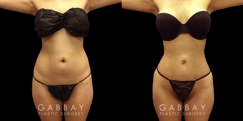 Female patient’s before-and-after photos showing how her abdominal lipo procedure enhanced her hourglass figure, slimming down both her waist and her stomach for a fit-looking contour from all angles.