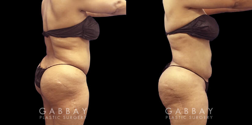 Female patient approaching her target body weight who wanted to remove stubborn fat that was resisting exercise. Abdominal lipo surgery allowed for encouraging slimming of her stomach and waist areas.