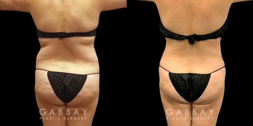 Mid 40s female patient after abdominal liposuction results have full healed, showing a tightened lower torso with belly rolls smoothed out for a flatter overall contour.