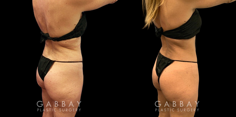 Before-and-after liposuction for the abdomen, showcasing the patient’s flatter stomach. Note how her abdominal muscle contouring is now visible, lending an exceedingly fit aspect to her aesthetic.