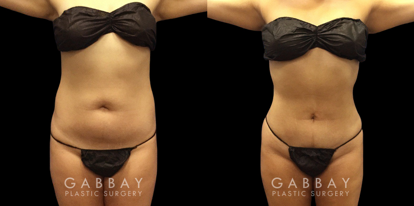 Female patient with enhanced abdominal contours after 360 liposuction surgery. Note the flattened stomach and the dynamic shape to her waist, restoring her natural curves.