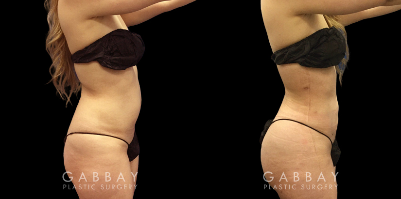 Before-and-after photo for 360 and abdominal liposuction combination. Note the emphasized contour of the waist, which in turn emphasizes the roundness of the buttocks.