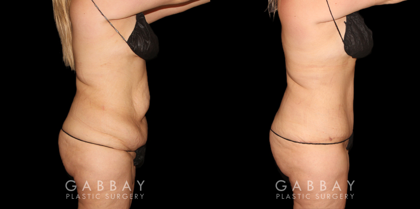 Patient 04 Right Side View Tummy Tuck with Lipo Gabbay Plastic Surgery