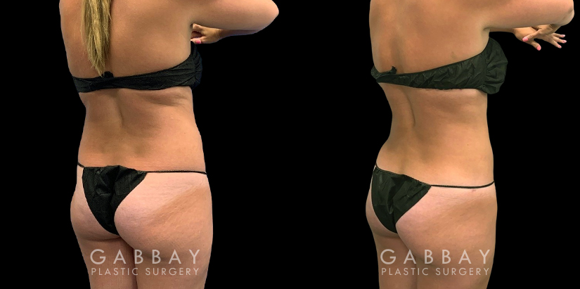 Patient after mild liposuction, demonstrating a significantly flatter stomach area from the profile angle. Patient’s recovery was without complications, and lead to virtually no visible scarring.