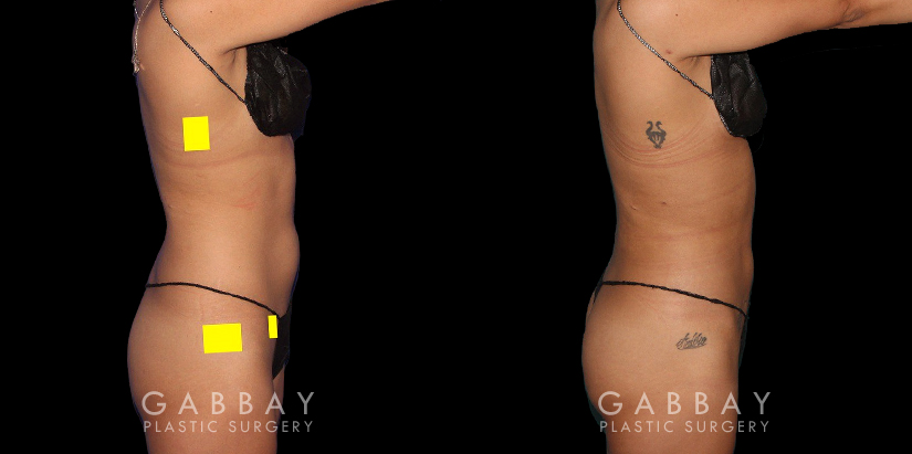 Before-and-after for patient with combined cosmetic surgeries, including BBL, abdominal lipo. Note the 360-degree slimming with enhanced buttocks roundness from the natural fat transfer.