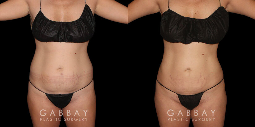 Results for a patient with 360 liposuction for abdomen, waist, and tailbone for a BBL fat transfer surgery. Note the flattened stomach and enhanced shape of the buttocks for a more impressive figure overall.