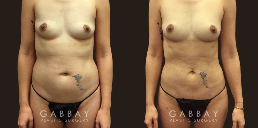 Patient sought to remove final stubborn pockets of belly fat, restoring a more youthful figure and enhancing her natural figure.