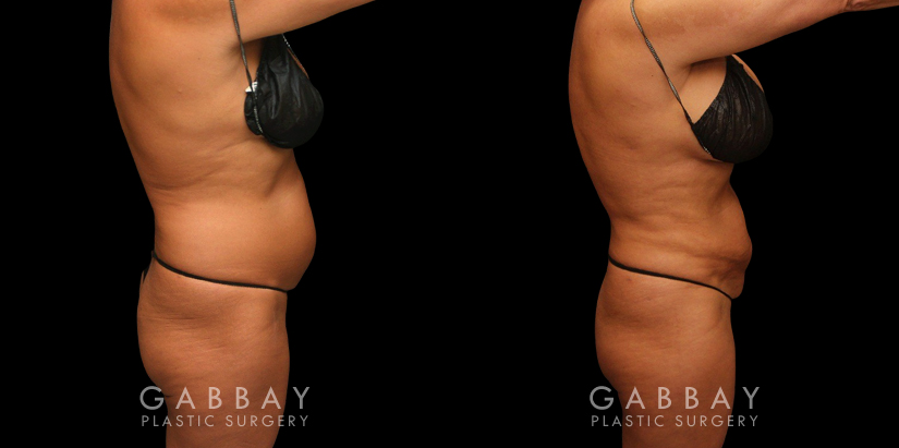 Female African-American patient after liposuction and J plasma treatment to her full abdomen, reducing her bulging belly and to tighten and restore loose skin.