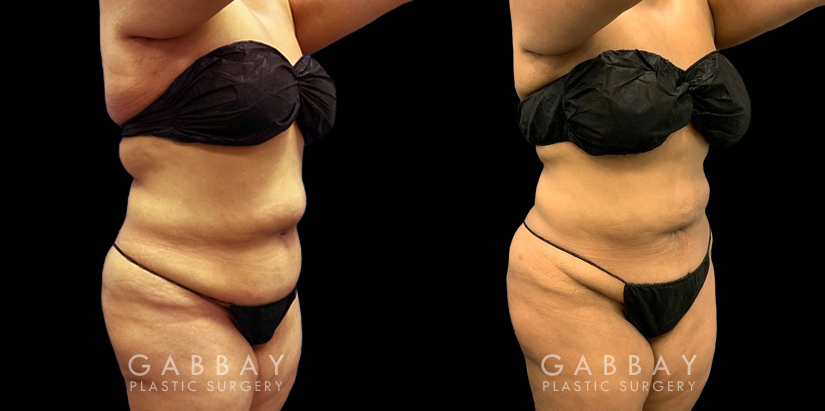 Patient after a traditional liposuction for the stomach (abdominal) area, resulting in a decrease in bulging belly fat (rolls) with a notable restoration of her natural body shape.