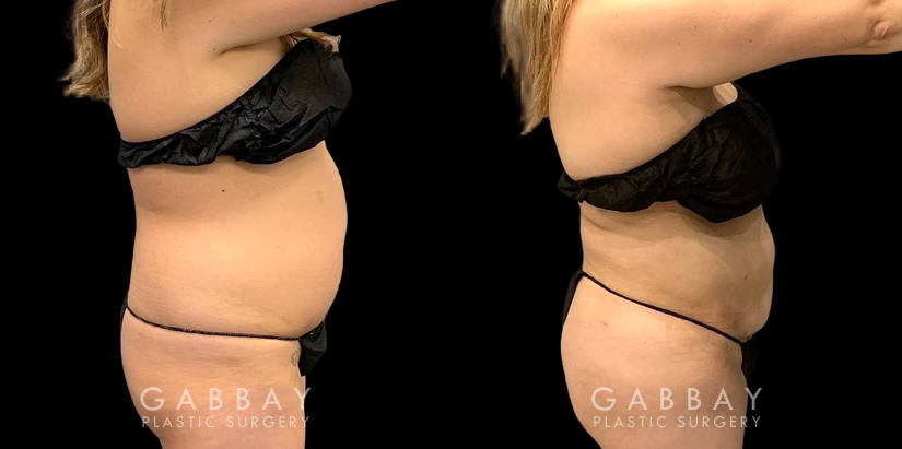 Female patient in her middle years after an abdominal liposuction surgery. The slimmed portions of the stomach area contribute to a more shapely appearance overall.