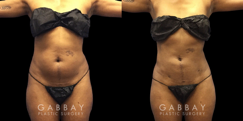 Female patient with notable contouring of the abdominal area after liposuction, resulting in a more youthful figure free from any bulging fat deposits.