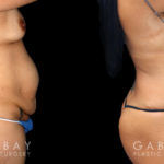 Before and after tummy tuck combined with hernia repair. By removing fat, tightening loose skin, and repairing the abdominal wall, Dr. Gabbay restored a slimmer, healthy appearance to the stomach area and tissues.