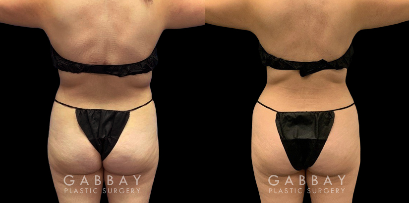 Patient who wanted mild liposuction to reduce tummy bulge from stubborn fat, with subtle results that lend a more balanced figure. Note how the puncture sites healed well for little to no visibility.