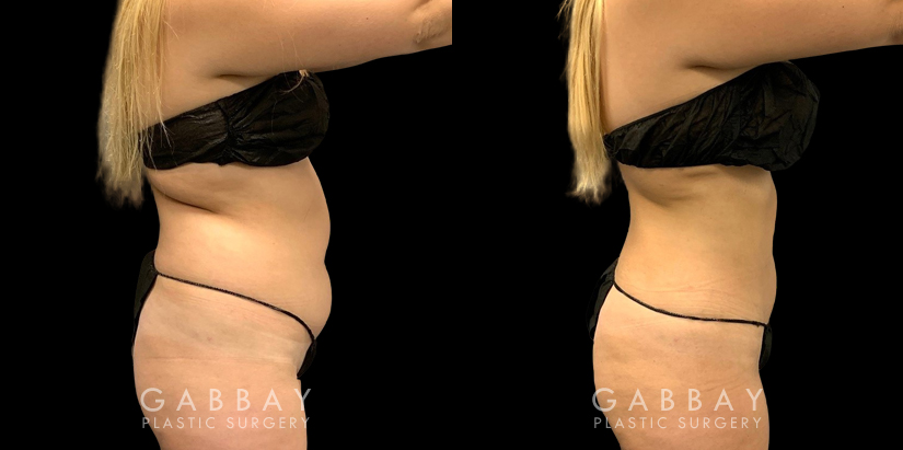 Before and after liposuction surgery for reducing mild bulging pockets of fat on the upper and lower abdomen, restoring a tighter stomach appearance without and bulging fat.