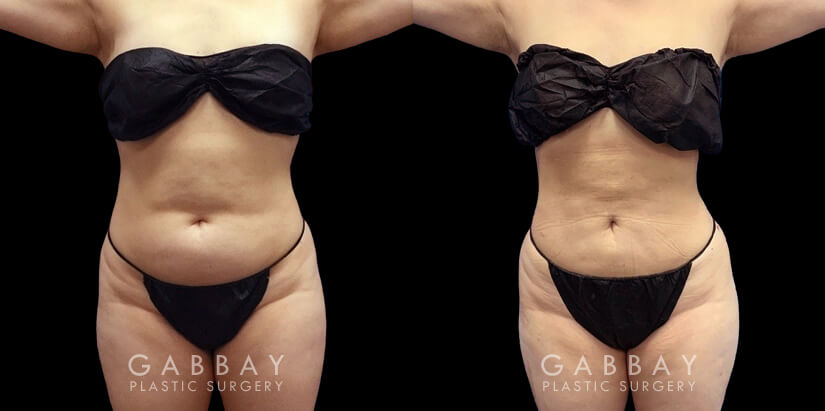 Abdominal liposuction results for a Caucasian patient who wanted to address pockets of belly fat that would not go away. The procedure removed the fat and produced a flat profile with a tighter tummy appearance.