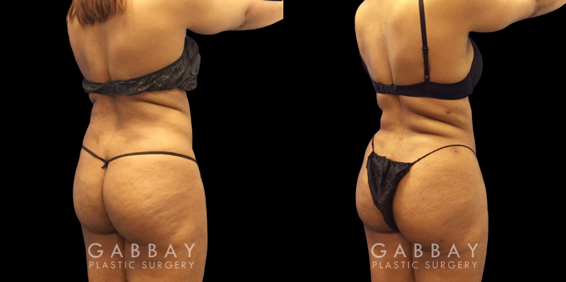 Younger female patient showcasing her results after belly fat removal via liposuction surgery. Note the reduction of ‘love handles’ and a flatter stomach for a defined lower torso aesthetic.